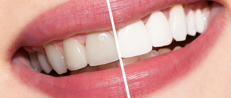 Teeth Whitening for Teenagers